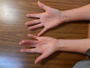 Dupuytren's contracture