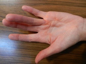 Dupuytren's Contracture